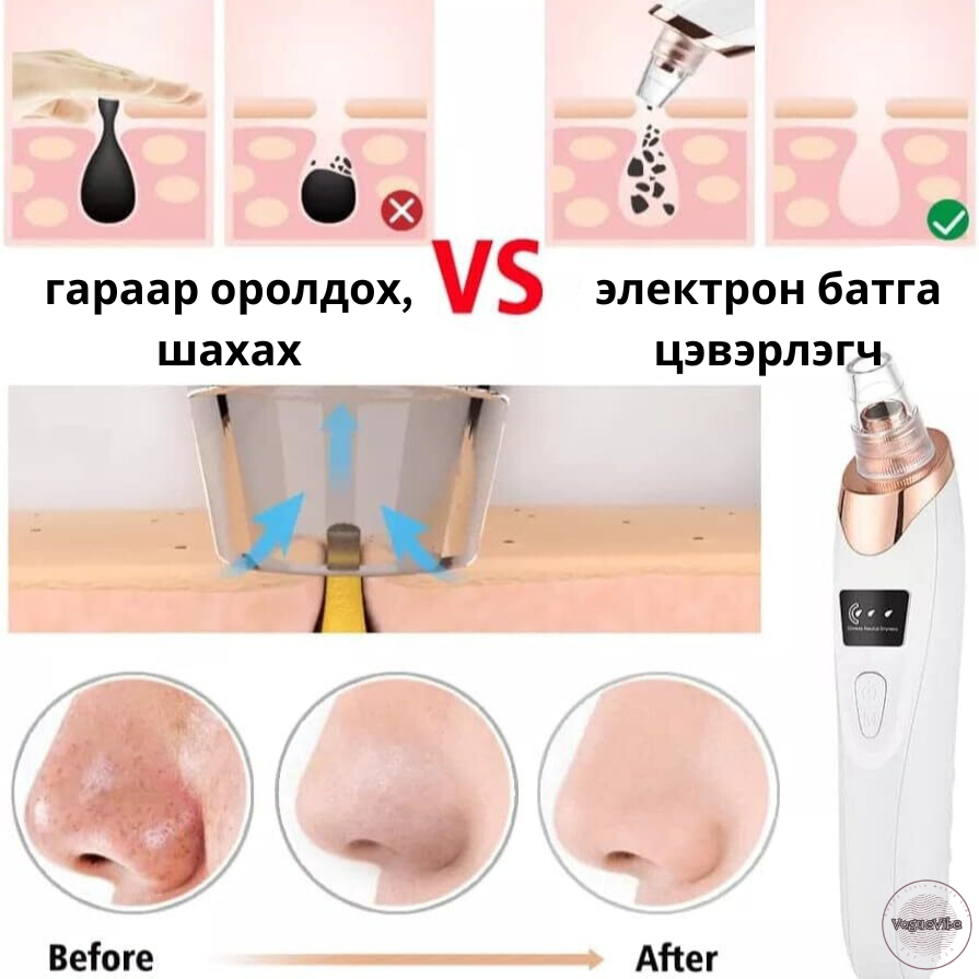 DermaSuction Батга цэвэрлэгч төхөөрөмж